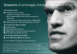 acromegaly