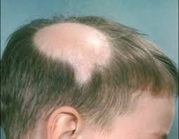 alopecia