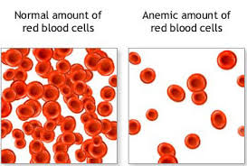 anaemia