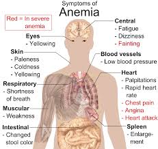 anemia