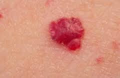 angioma