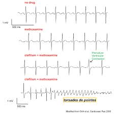 arrhythmic