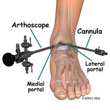 arthroscopy