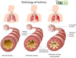 asthma