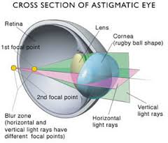 astigmatic