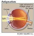 astigmatism