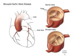 bicuspid