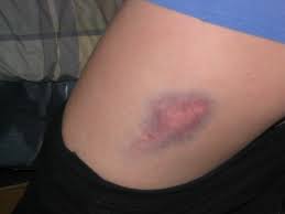 bruise