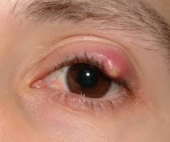 chalazion