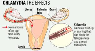 chlamydia