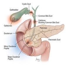 cholecystitis