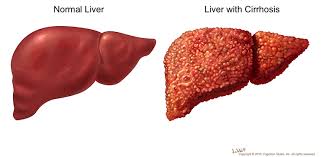 cirrhosis