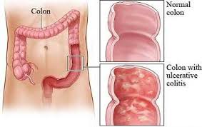 colitis