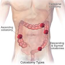 colostomy