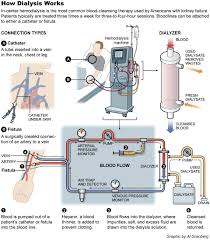 dialysis