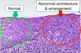 dysplasia