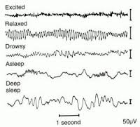 electroencephalogram