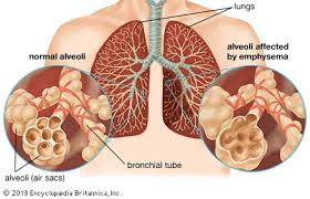 emphysema