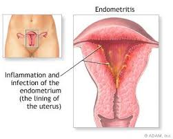 endometritis