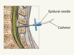 epidural