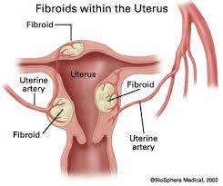 fibroid