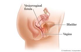 fistula