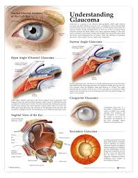 glaucoma