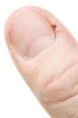 hangnail