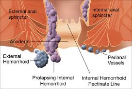 hemorrhoid