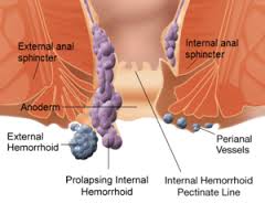 hemorrhoids