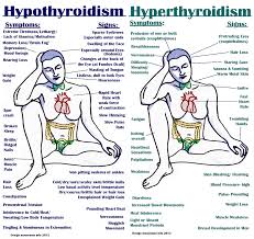 hyperthyroidism