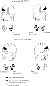 ipsilateral