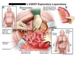 laparotomy