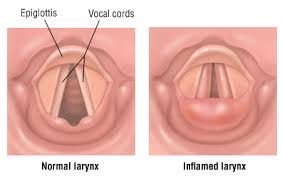 laryngitis