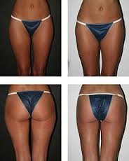 liposuction