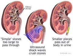 lithotripsy