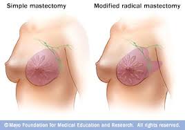 mastectomy