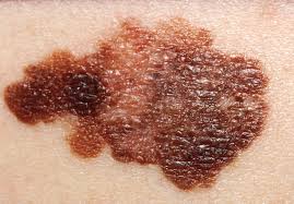 melanoma