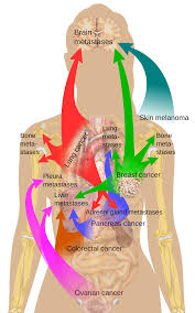 metastasis