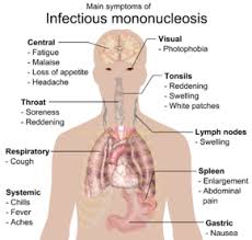 mononucleosis