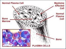 myeloma