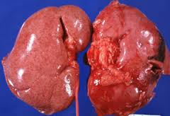 nephritis