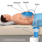 paracentesis