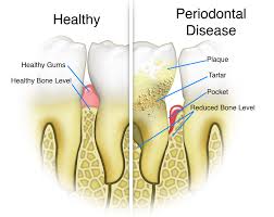 periodontal