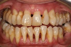 periodontitis