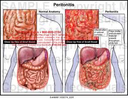 peritonitis