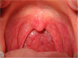 pharyngitis