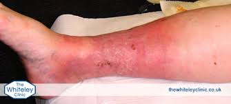 phlebitis