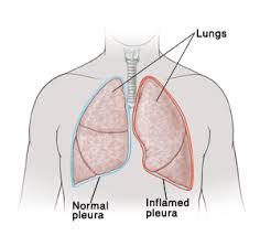 pleurisy