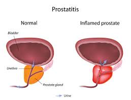 prostatitis